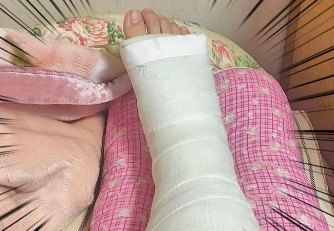 体験談 右足の骨折から日常生活を取り戻すまでの3か月 熊本 東京のホームページ ウェブ制作会社 株式会社エフ